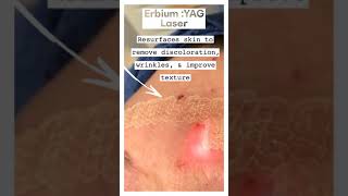 Erbium YAG laser skin resurfacing [upl. by Hoffer]