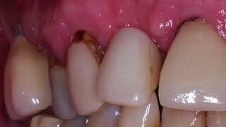 Cariology Part 7 Types of Caries [upl. by Aylad]