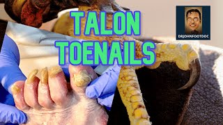 Podiatrists Cuts Toenails So Long They Look Like TALONS [upl. by Dilahk430]