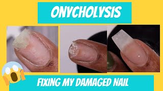 Onycholysis Uuggghh I damaged my nail  Fixing my separated damaged nail [upl. by Leunamnauj]