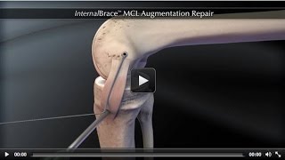 InternalBrace™ MCL Augmentation Repair [upl. by Pacheco627]