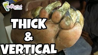 CUTTING SEVERE THICK NAILS HOW TO CUT THICK TOENAILS FUNGUS IN TOENAILS FUNGAL NAIL CURE [upl. by Ameehsat456]