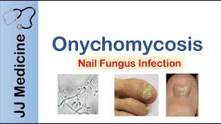 Onychomycosis  Nail Infection  Signs Symptoms Treatment [upl. by Briana]