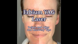 Erbium YAG Laser Treatment  Results and PostCare [upl. by Ecienahs714]