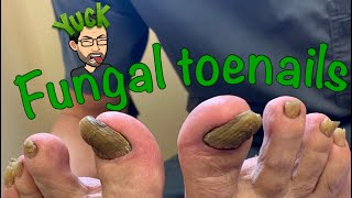 CUTTING LONG TOENAILS WITH FUNGUS [upl. by Rozek]