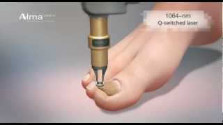 ClearChoice a dual laser approach to onychomycosis from Alma Lasers [upl. by Moneta]