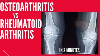 Osteoarthritis vs Rheumatoid arthritis in 2 mins [upl. by Alithea426]