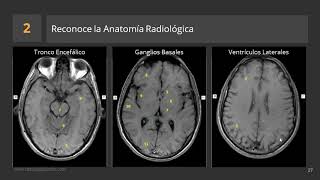 Cómo describir una RM de Cerebro [upl. by Lleznov]