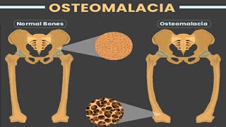 OSTEOMALACIA [upl. by Cornew]