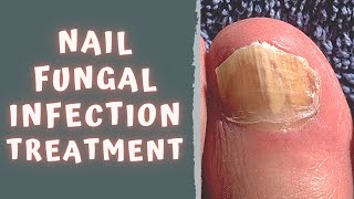 HOW TO TREAT FUNGAL NAIL INFECTION  TINEA UNGUIUM  ONYCHOMYCOSIS [upl. by Luhey]