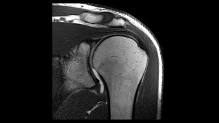 PROTOCOLO RESONANCIA MAGNETICA DE HOMBRO [upl. by Tamma]