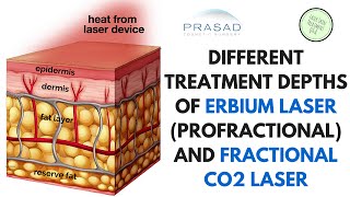 The Different Treatment Depths of ProFractional Erbium Laser and Fractional CO2 Laser [upl. by Sophey]