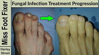 Nail Treatment Progression photo before and after by fungal nail expert [upl. by Dickie461]