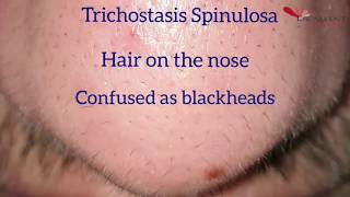 Hair removal on the nose by Laser  Trichostasis Spinulosa [upl. by Meece]