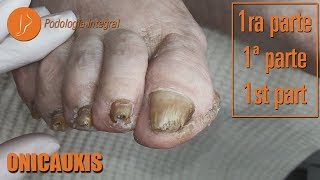 Onicauxis onychomycosis amp callosities Part 1 podologiaintegral [upl. by Dirgis]