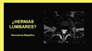 Hernias lumbares  Resonancia Magnética [upl. by Morven]