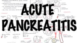 Acute Pancreatitis  Overview signs and symptoms pathophysiology investigations treatment [upl. by Rubie544]