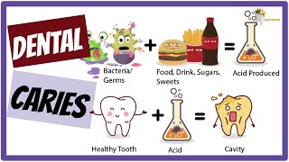 DENTAL CARIES Etiology Keyes Jordan diagram Stephans Curve SIMPLIFIED [upl. by Nilya643]