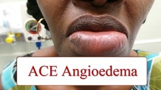 Angioedema  a medical minute [upl. by Gwenny209]