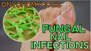 ONYCHOMYCOSIS  FUNGAL NAIL INFECTION  DEFINITION SYMPTOMS TREATMENT  EXPLAINED in 5 Minutes [upl. by Marguerita]