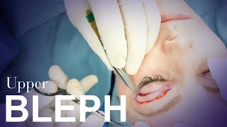 Upper Eyelid Blepharoplasty [upl. by Pinkham]