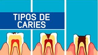 Tipos de caries  Odontoespecialistas [upl. by Turmel]