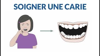 Comment soigner une dent cariée [upl. by Goldner432]