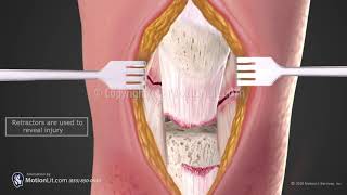 Patella Tendon Repair [upl. by Krasner]