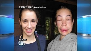 Anaphylactic Reaction Symptoms and Treatment [upl. by Dorry796]