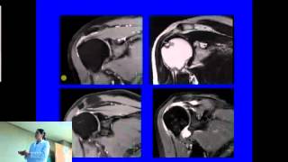 Resonancia Magnética Nuclear en Hombro [upl. by Samid]