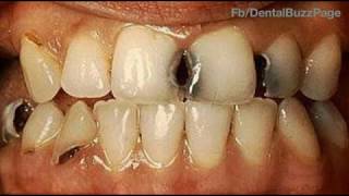 GV Blacks Classification of Dental Caries [upl. by Wilmar]