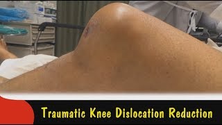 Traumatic Knee Dislocation Reduction [upl. by Adieno560]