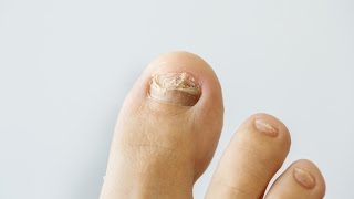 How to prevent and treat nail fungus [upl. by Lib]