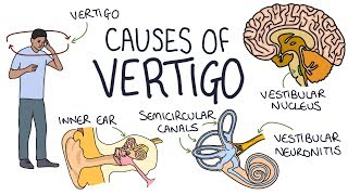 How to Perform the Epley Maneuver for Vertigo [upl. by Dedie]