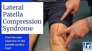 Lateral Patella Compression Syndrome LPCS [upl. by Barth]