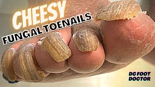 Cheesy Fungal Toenails Trimming Long Toenails [upl. by Llerrac205]