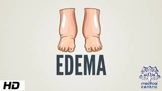 The Eight Causes Of Edema  Dr Berg [upl. by Pride]