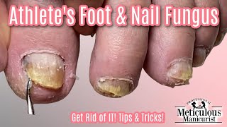 Reverse Nail Fungus Caused by Athletes Feet [upl. by Ahsropal]