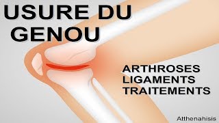 LUsure du Genou Arthrose Ligaments Nouveau Traitement Espoir [upl. by Lionel976]