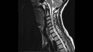 Anatomía RM Cervical [upl. by Attelliw]