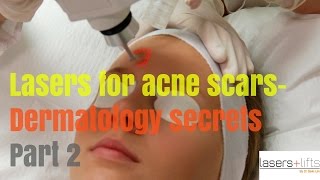 Laser Resurfacing for ACNE SCARS Secrets revealed [upl. by Aratas]