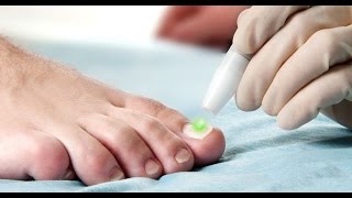 Toenail Fungus Onychomycosis treatment using the FOX Laser [upl. by Relyc]