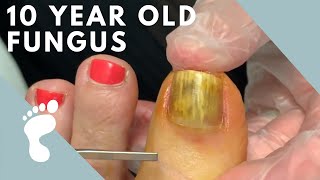 Fungus Takes Over Toenail  Toenail Removal [upl. by Beauvais]