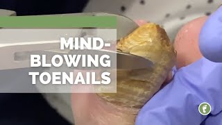 MIND🤯BLOWING TOENAILS [upl. by Luing]