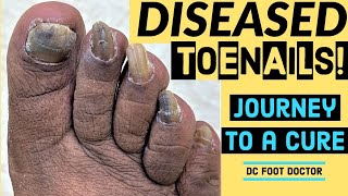 Diseased Toenails Journey To A Cure Trimming Fungal Toenails Onychomycosis [upl. by Lisabeth]