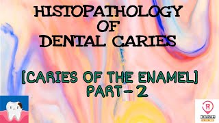 HISTOPATHOLOGY OF DENTAL CARIES  CARIES IN THE ENAMEL PART2 [upl. by Iglesias]