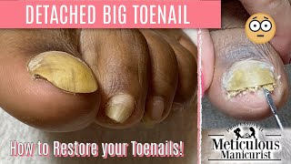 How To Pedicure Transformation for Men on Detached Toenails [upl. by Ayit]