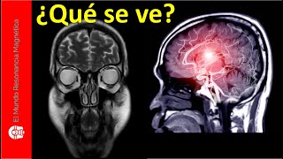 ¿Cómo se hace una Resonancia Magnética CEREBRAL o de la cabeza¿Con Contraste o SIN contraste telde [upl. by Anawak210]