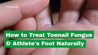 How to Treat Toenail Fungus amp Athletes Foot Naturally [upl. by Sayed880]