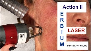 Action II Erbium Laser [upl. by Arvonio]